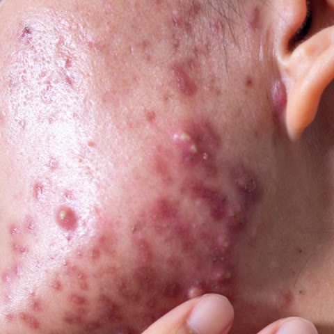รุนแรงมาก: มีตุ่มแดง ตุ่มหนอง ตุ่มนูน และ ซีสต์จำนวนมาก